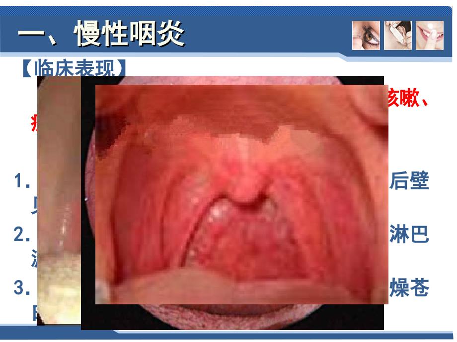 五官科学第六章耳鼻咽喉科常见疾病3咽部疾病图文课件_1_第4页
