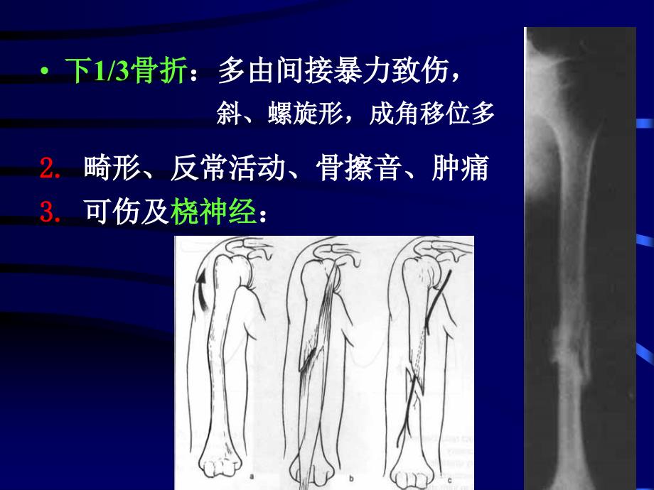 肱骨外科颈骨折课件_4_第4页