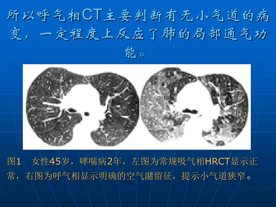 如何阅读肺部弥漫性病变的ct片课件_第4页