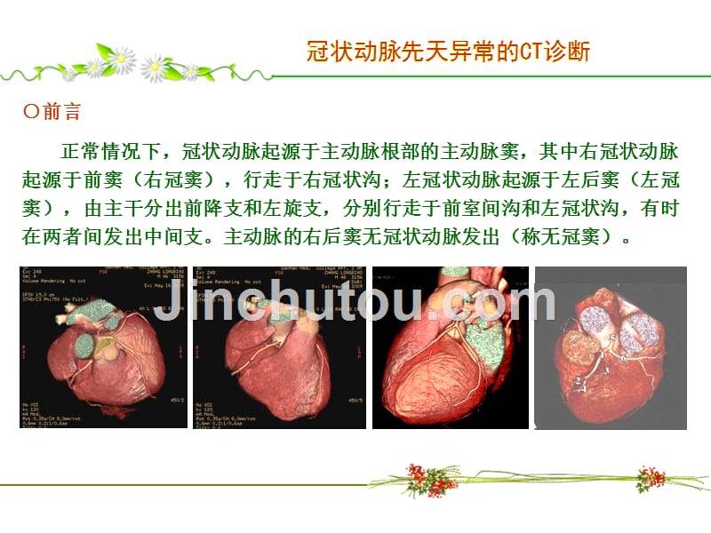 冠状动脉先天异常的ct诊断课件_第3页