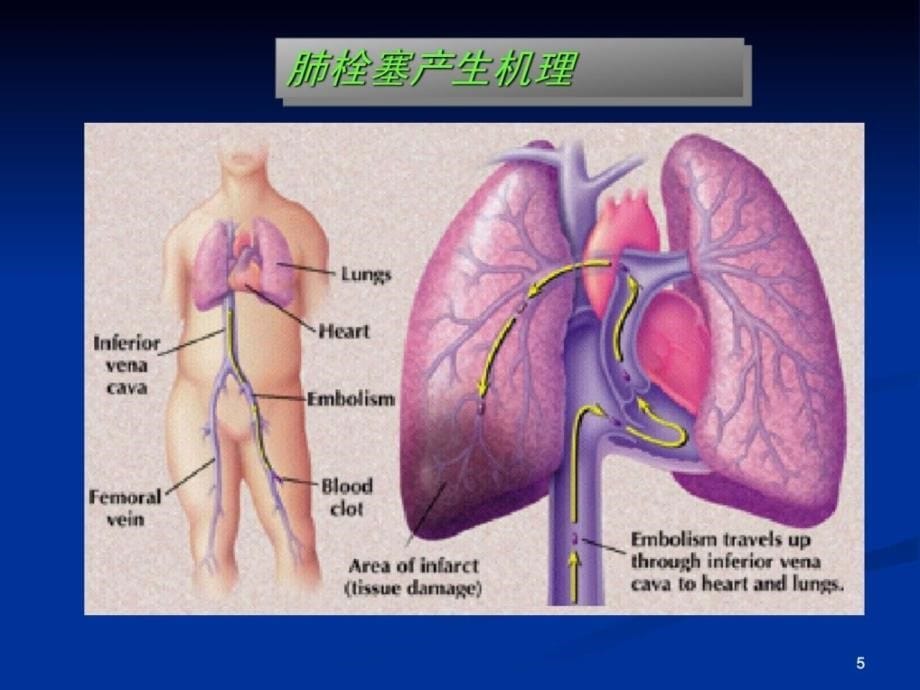 骨科大手术发生深静脉血栓的危险因素分析课件_第5页