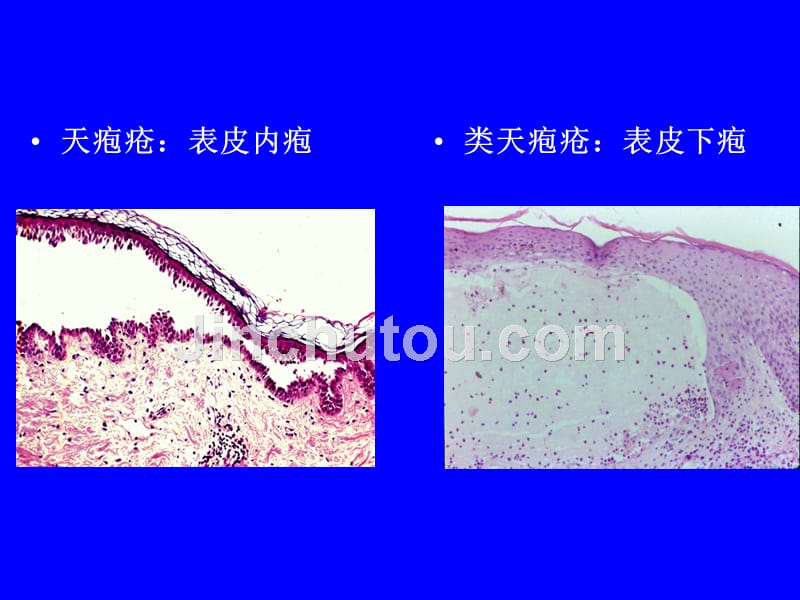 教学研究大疱性皮肤病（本）课件_第5页