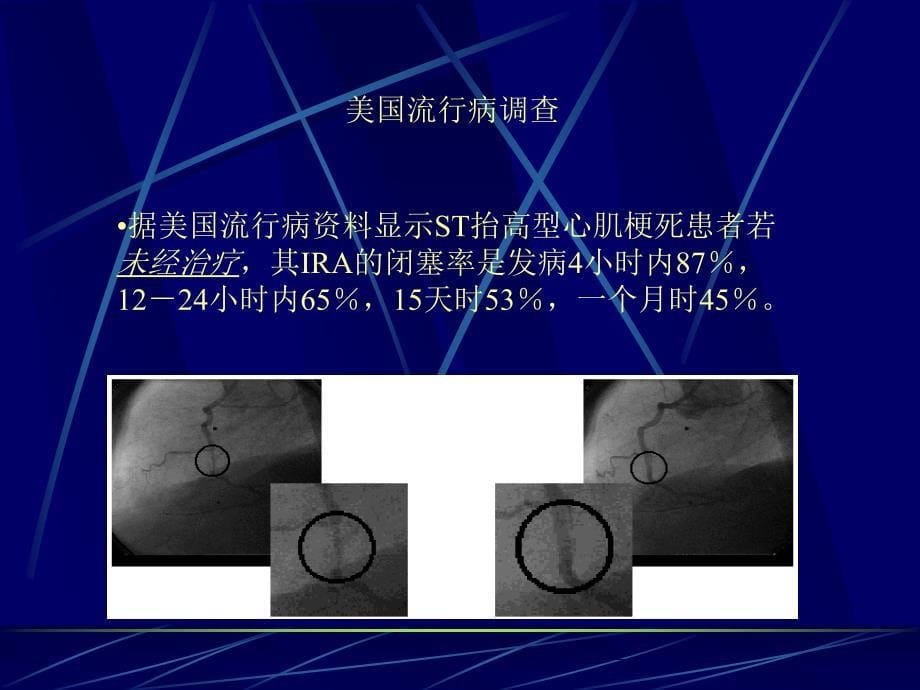 择期冠状动脉介入治疗对左室课件_第5页