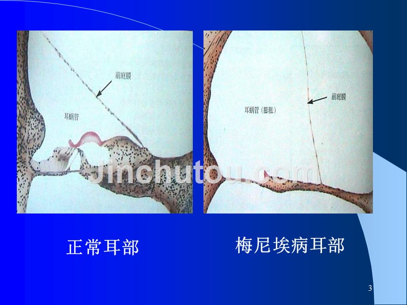 梅尼埃病及耳聋防治（2014）课件_第3页