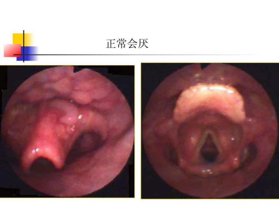 急性会厌炎图文课件_1_第3页