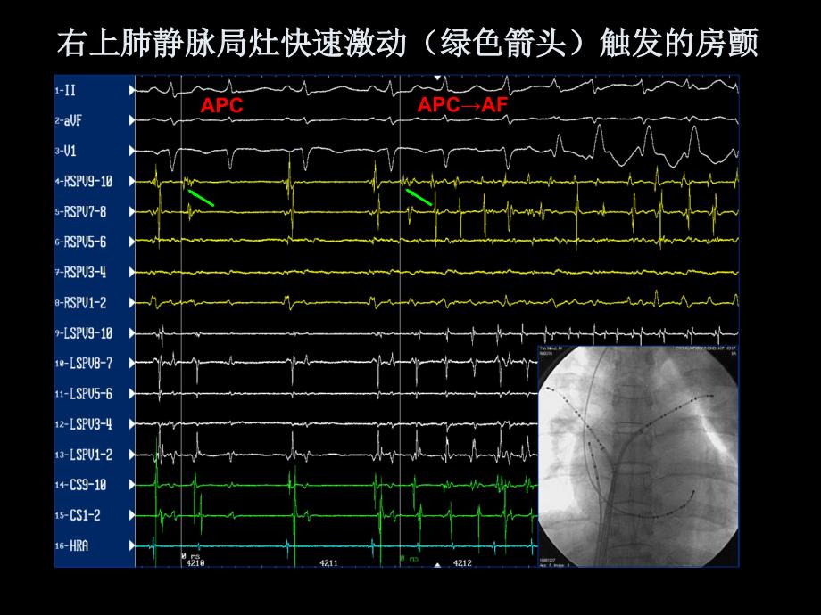 精品课件教案ppt 房颤的射频消融治疗_第4页