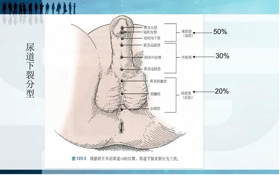 尿道下裂常用术式课件_第5页