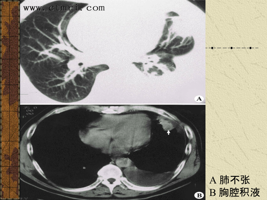 医学资料07肺痿肺痈咳嗽上气病脉证治第七课件_第4页