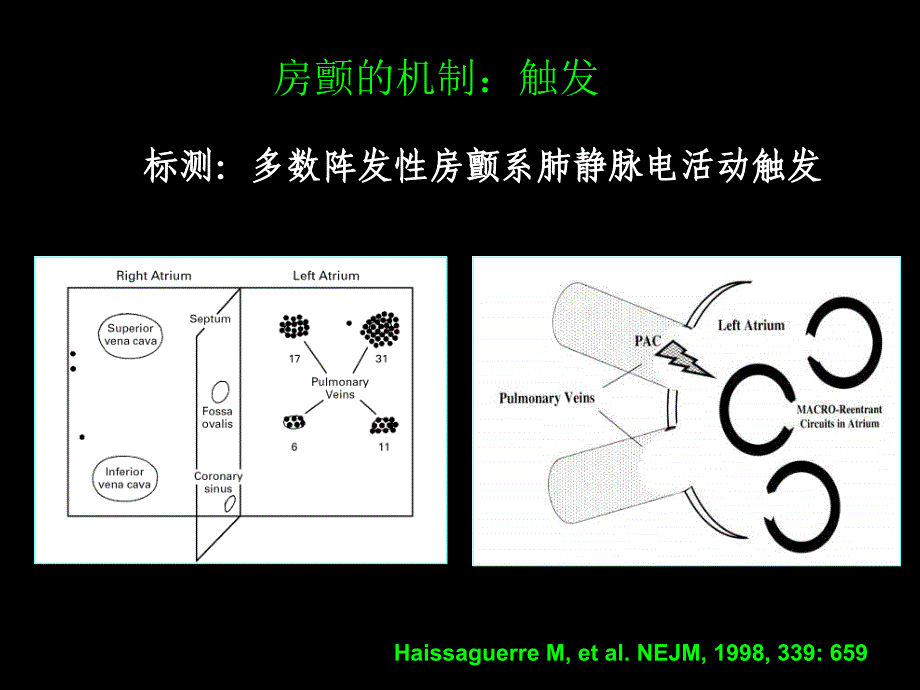 （课件）房颤的射频消融治疗_第3页