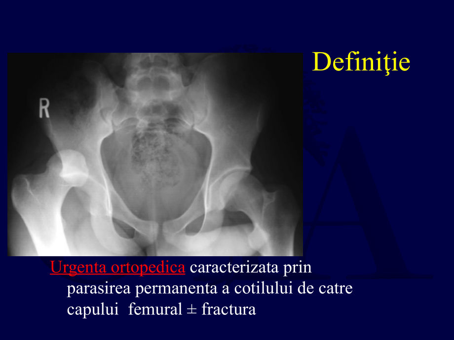 dislocations and femoral head fractures髋关节脱位股骨头骨折课件_第2页