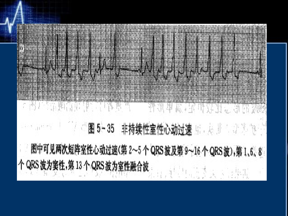 室性心动过速课件_1_第4页