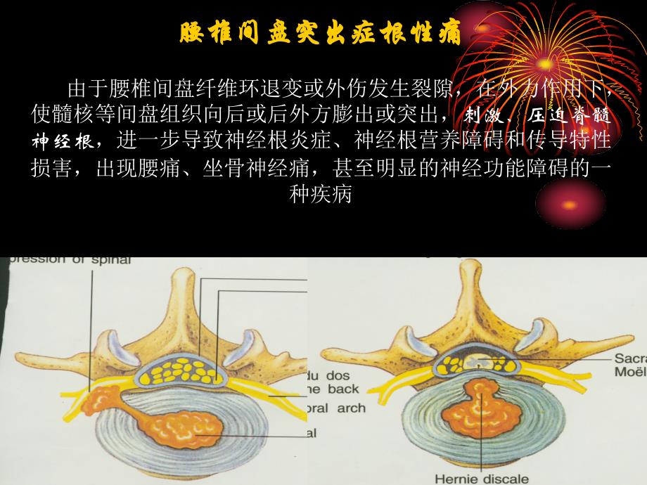 椎间盘突出症的针灸治疗课件_第3页