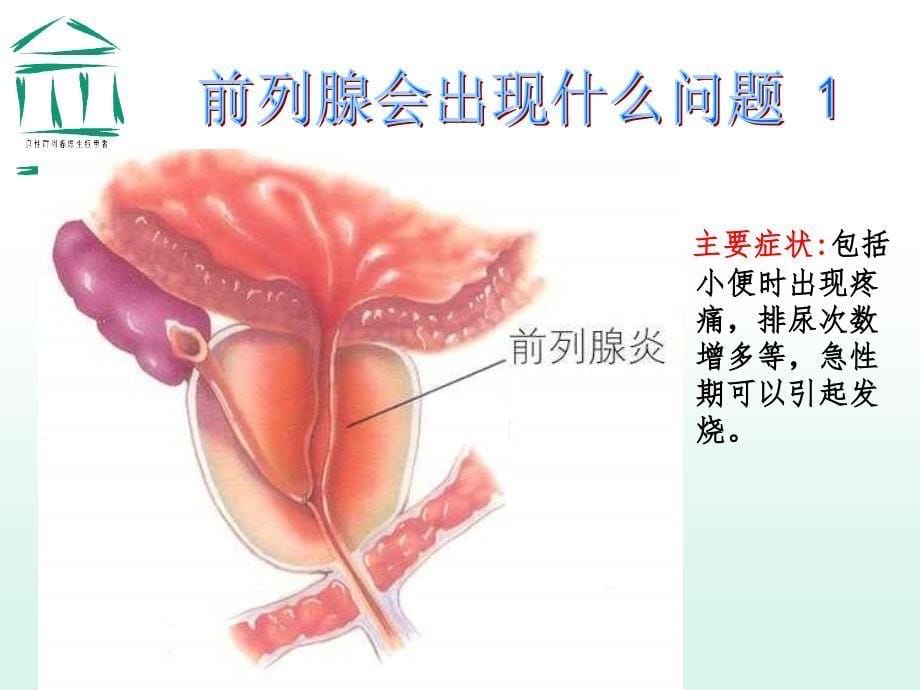 前列腺增生症健康教育讲座（taoweiqi）ppt课件_第5页