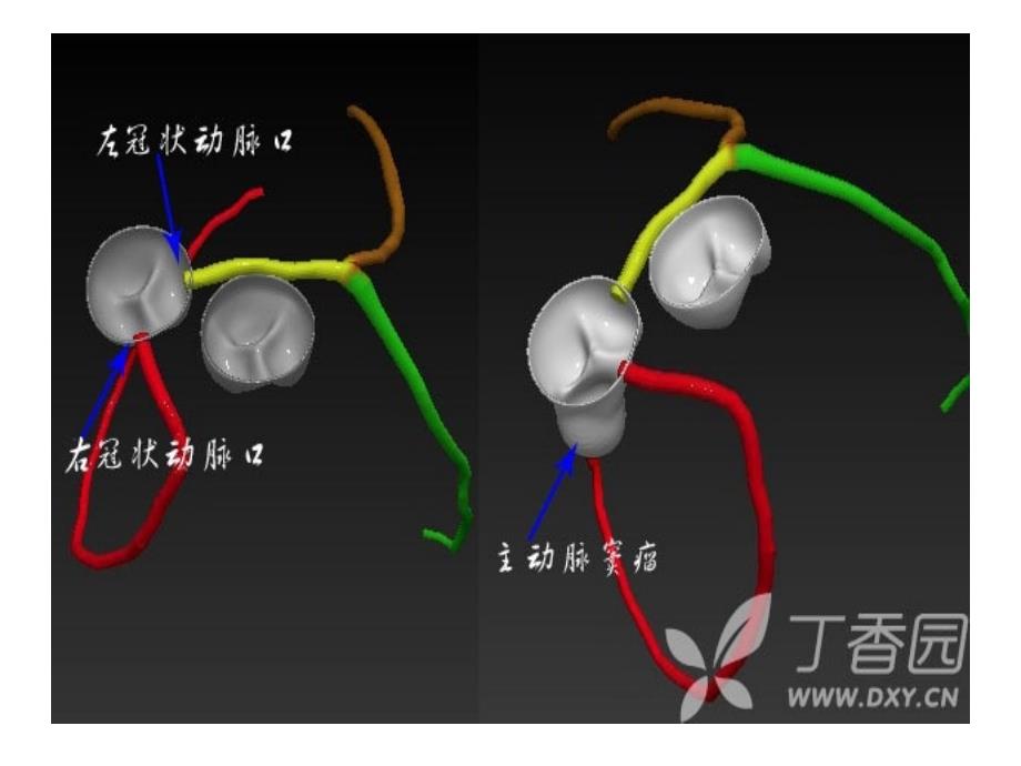 冠状动脉解剖课件_第2页