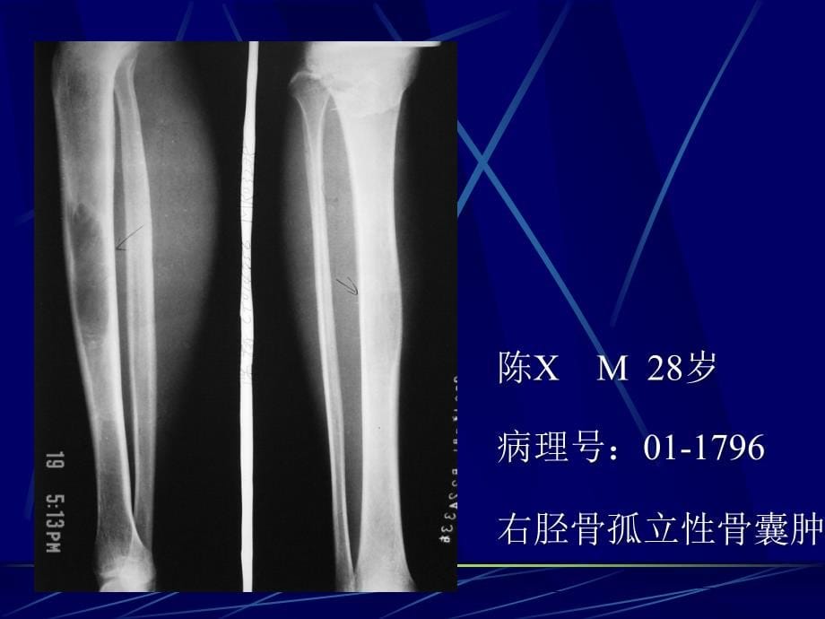 样病变的影像学诊断之三（骨囊肿）课件_第5页