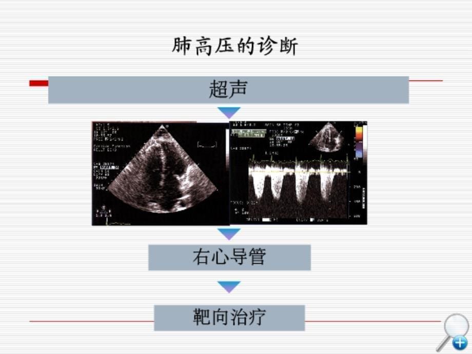 右心导管技术及急性血管反应实验的临床应用课件_第5页