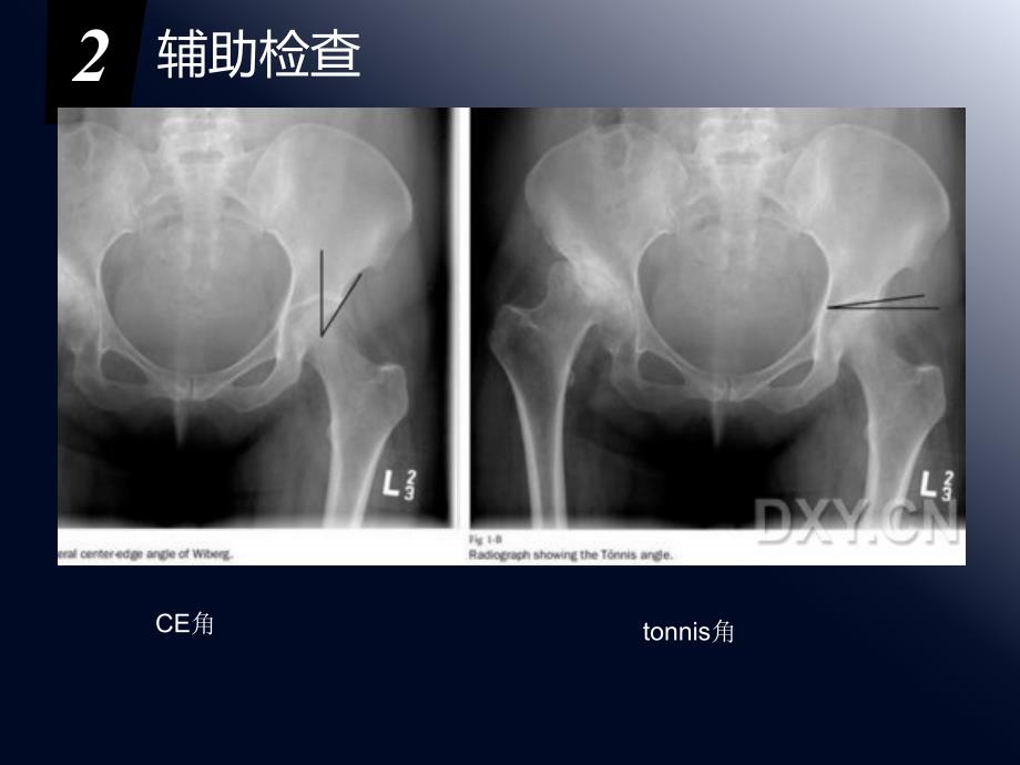 成人髋关节发育不良治疗新进展精品课件_第3页