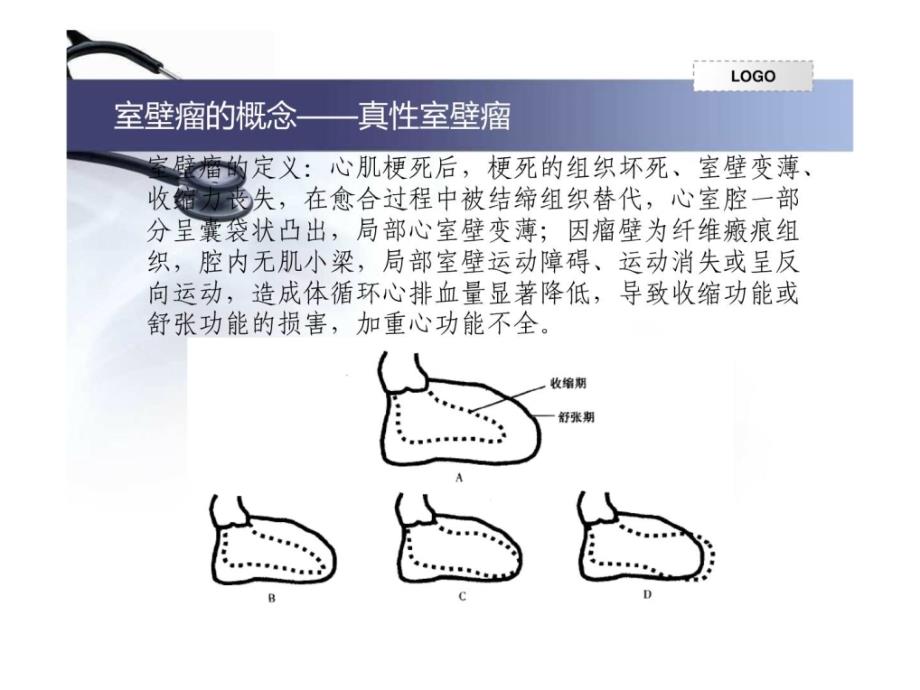 室壁瘤的诊治概略课件_第2页