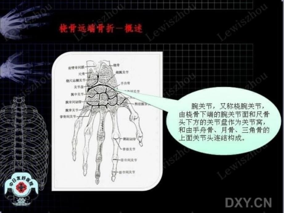 桡骨远端骨折腕背侧24mmlcp固定及三柱理论的应用课件_第5页