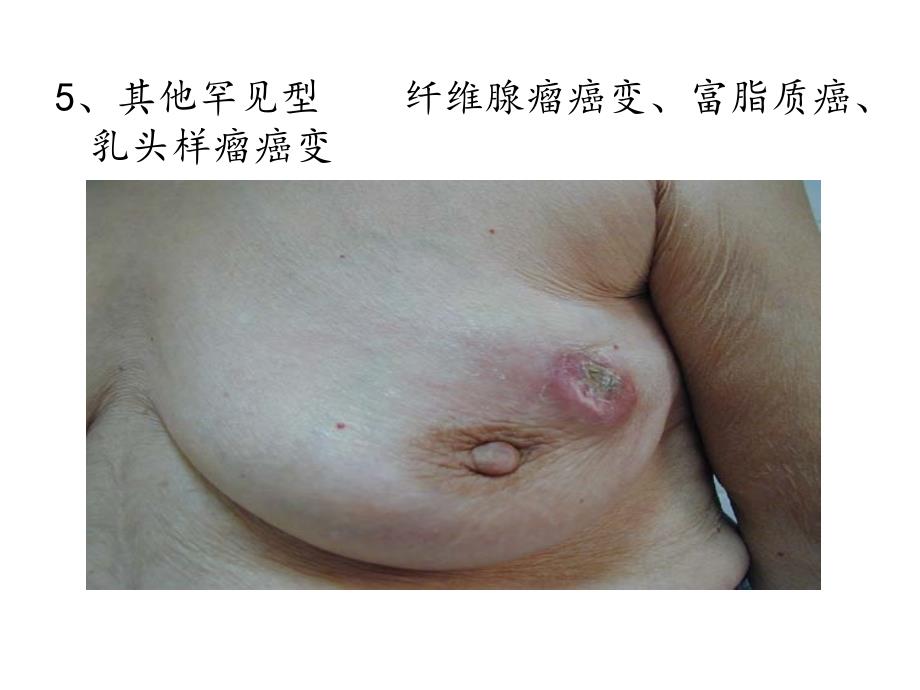 乳腺癌311 ppt课件_第4页