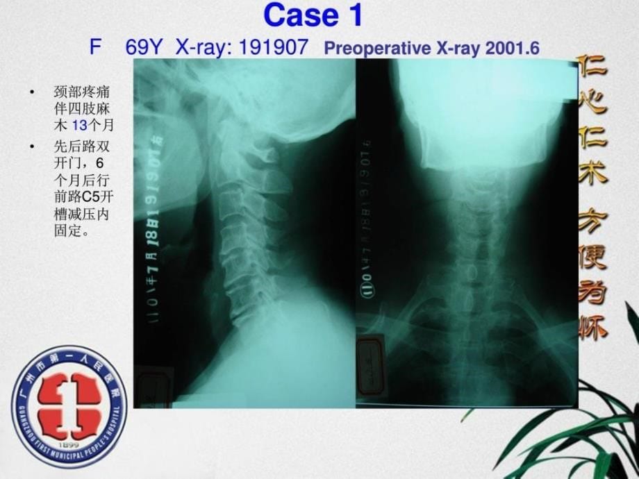 最新温世锋一期后前路手术治疗多节段脊髓型颈椎病图文课件_第5页