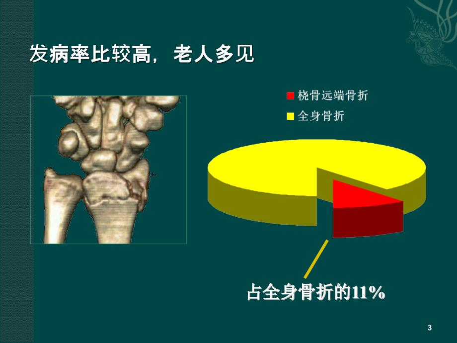 桡骨远端骨折课件_1_第3页