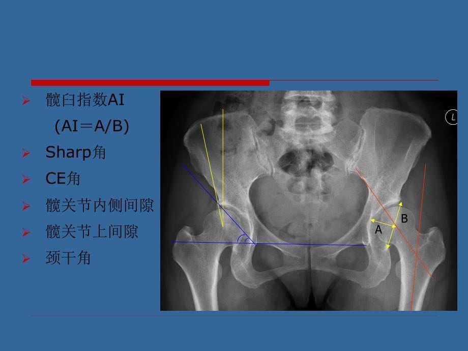 成人髋关节发育不良治疗新进展课件_1_第5页