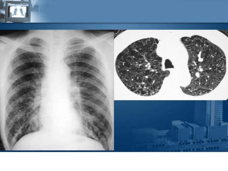 推荐医学影像诊断ppt课件图文详解完整版-呼吸系统影像学.ppt_第3页