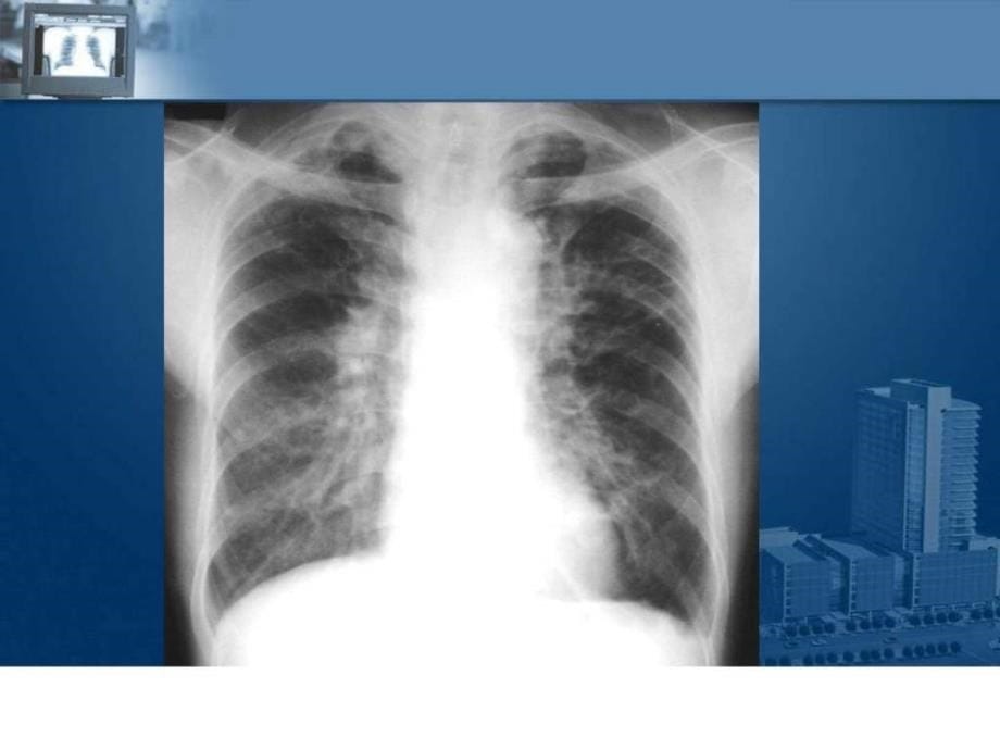 推荐医学影像诊断ppt课件图文详解完整版-呼吸系统影像学.ppt_第5页