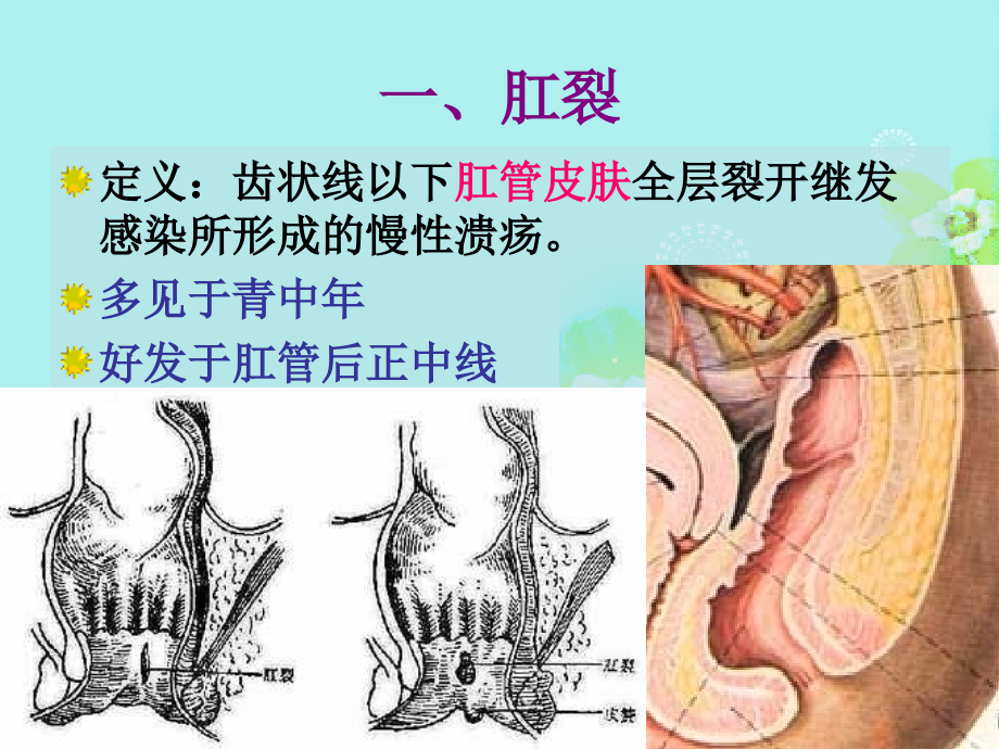 直肠肛管疾病课件_1_第3页