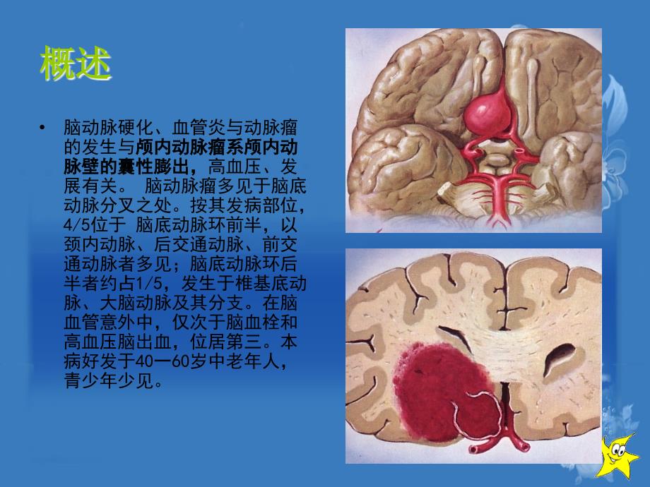 医药卫生动脉瘤课件_第3页