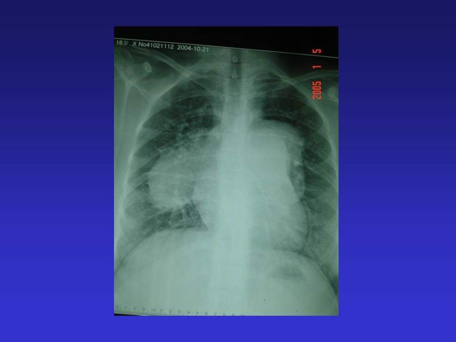 原发性肺动脉高压课件_第4页