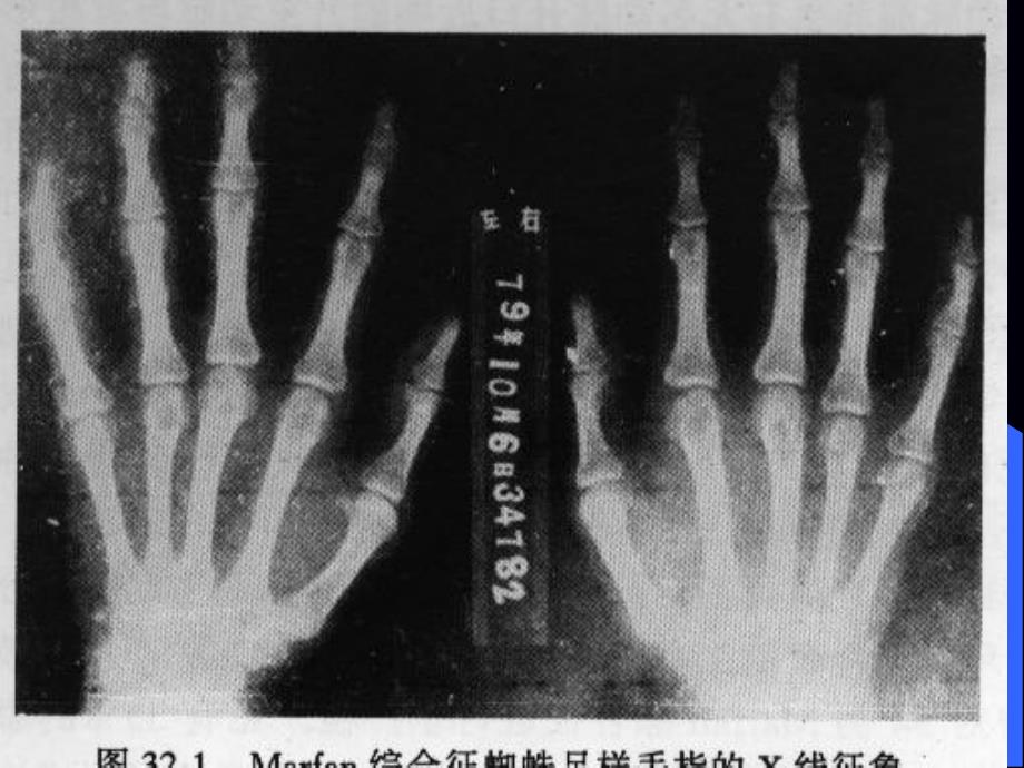 主动脉夹层动脉瘤主动脉夹层分离课件_1_第4页