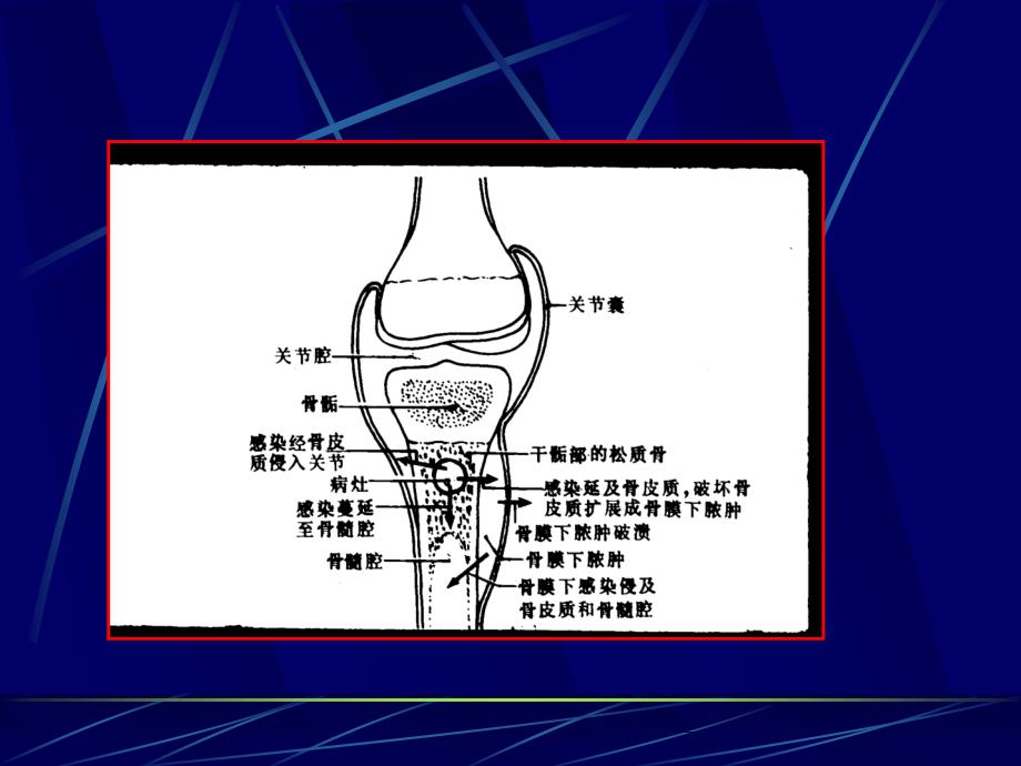 医学柯维旭化脓性骨髓炎的影像学诊断课件_第4页