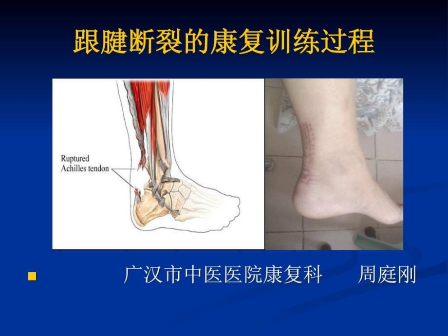 宝典跟腱断裂的康复课件_第1页