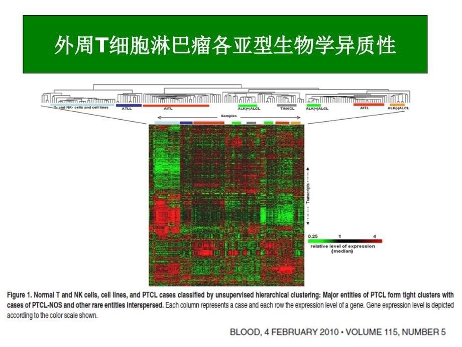 外周t细胞淋巴瘤讲稿修改课件_第5页