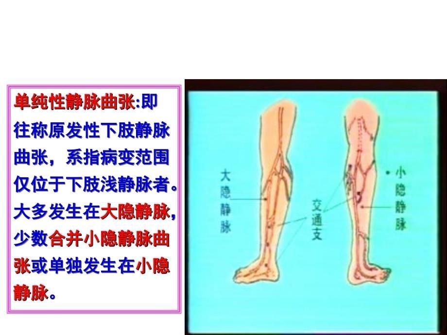 周围血管疾病病人的护理课件_1_第5页