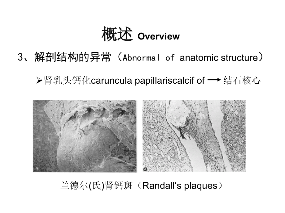 泌尿系结石的诊疗课件_第4页