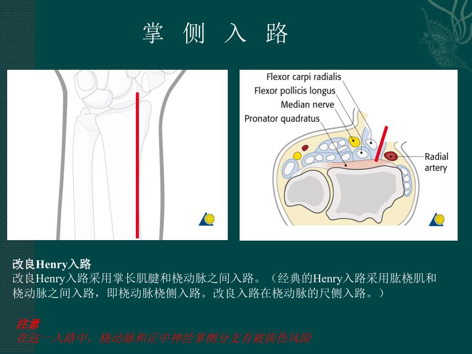 桡骨远端骨折课件_3_第4页