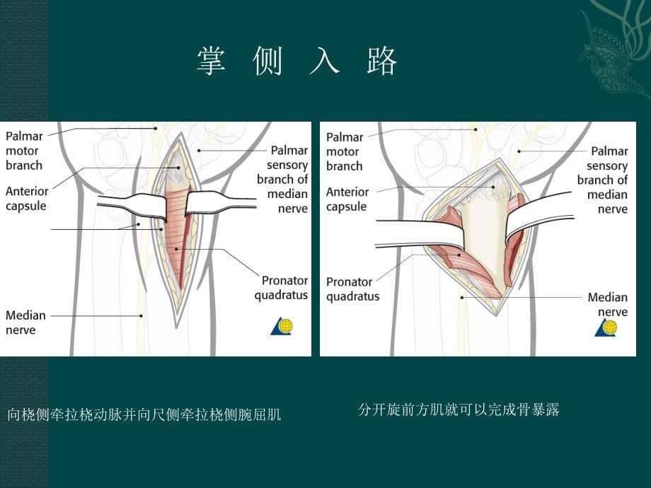 桡骨远端骨折课件_3_第5页