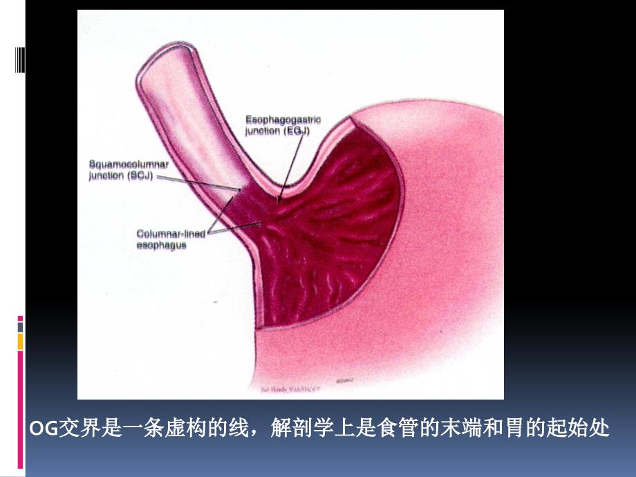 胃肠道肿瘤病理课件_第4页