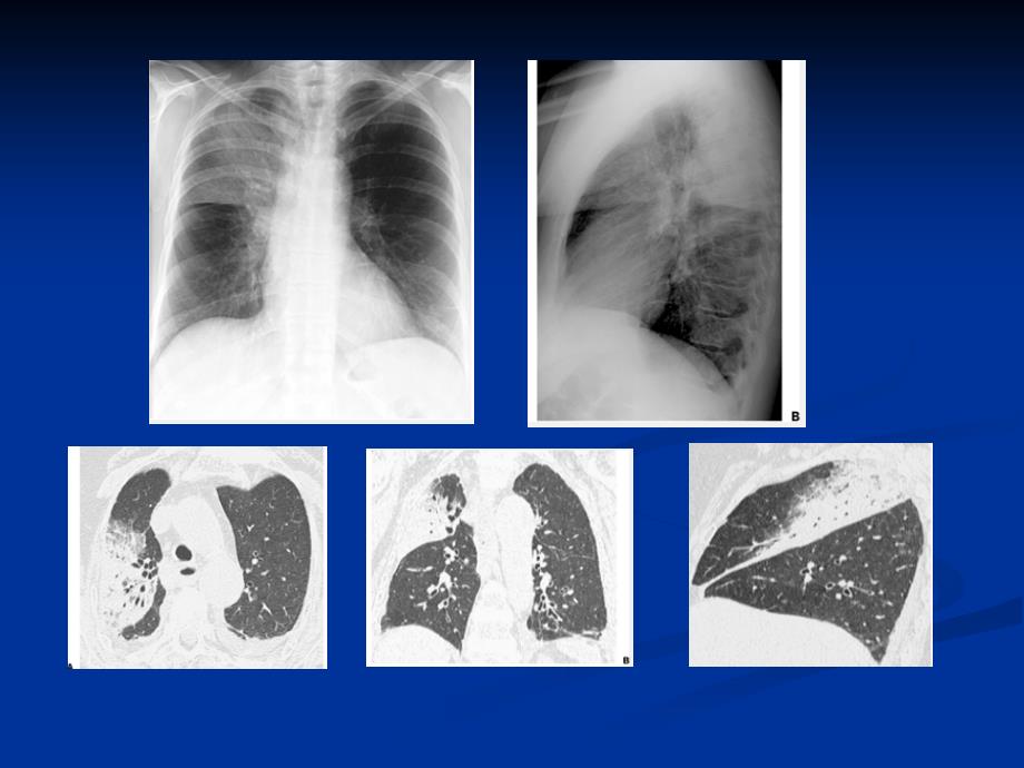 肺部感染-影像学和病理_ppt课件_第4页