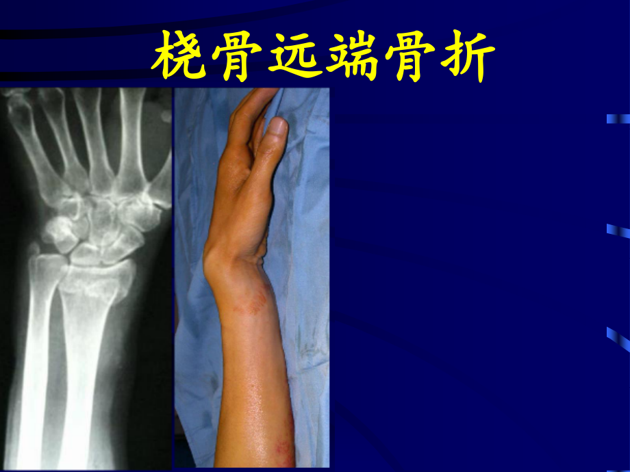 《中西医结合骨伤科学》13桡骨远端骨折课件_第1页
