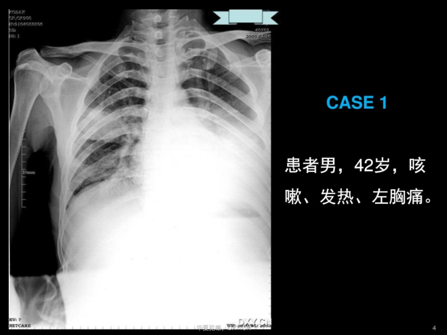 炎症结核肿瘤在ct及胸片上的区别课件_2_第4页