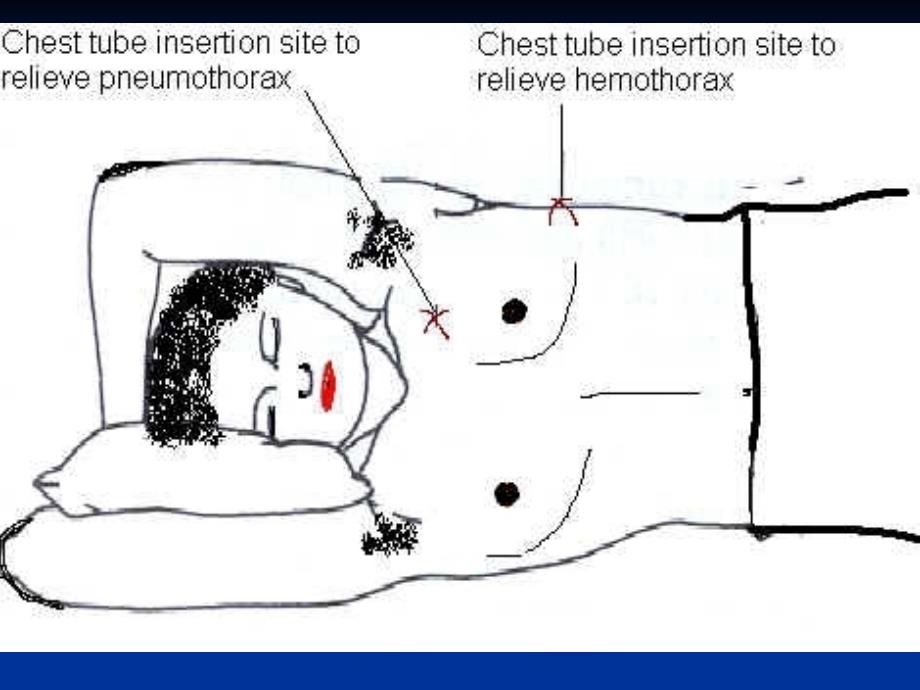 胸腔闭式引流护理英文课件_第4页