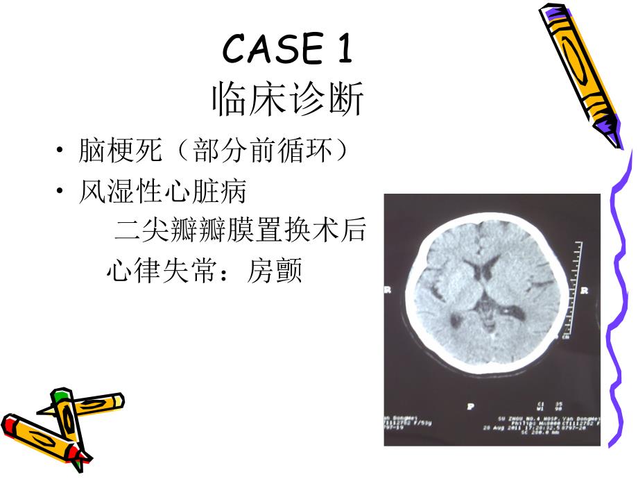 医学ppt溶栓病例分析课件_第4页