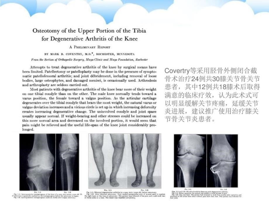 胫骨高位截骨术临床医学医药卫生专业资料课件_第5页