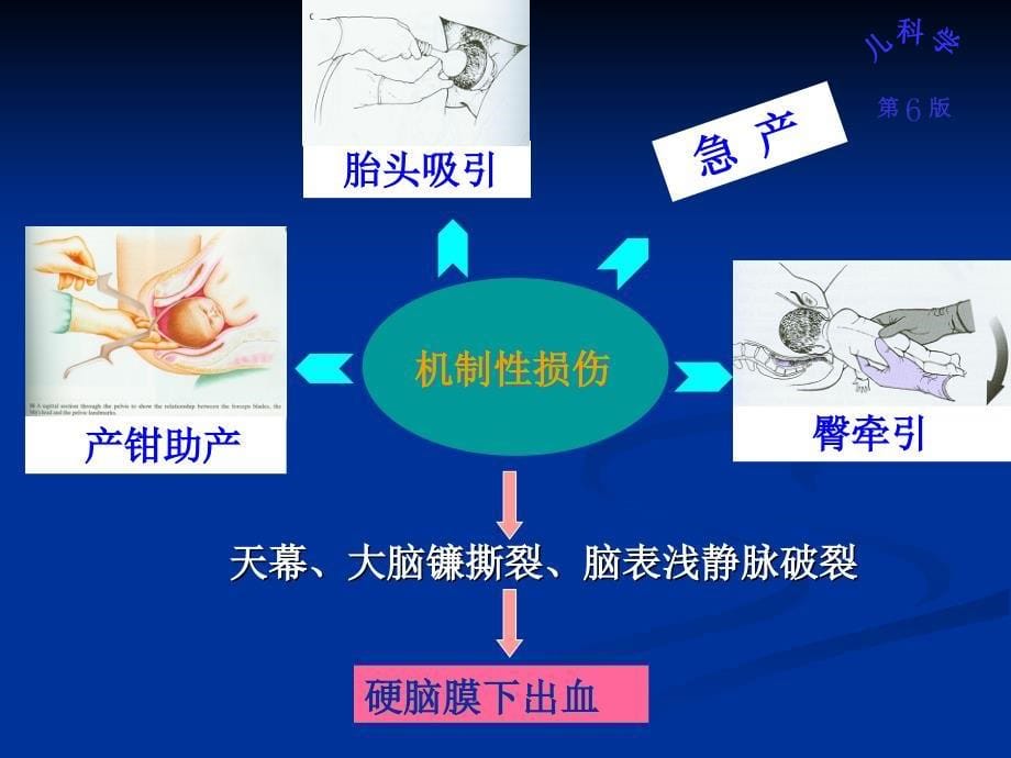 儿科学课件新生儿颅内出血_第5页