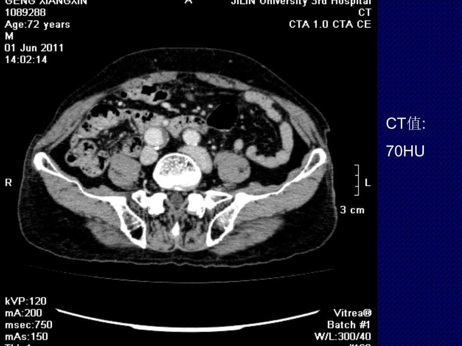 胃肠道间质瘤的ct特点课件_第5页