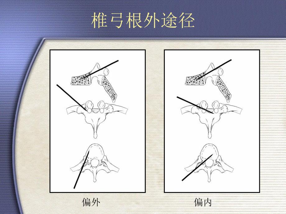 可膨胀球囊式 压迫性骨折椎体复位系统课件_第4页